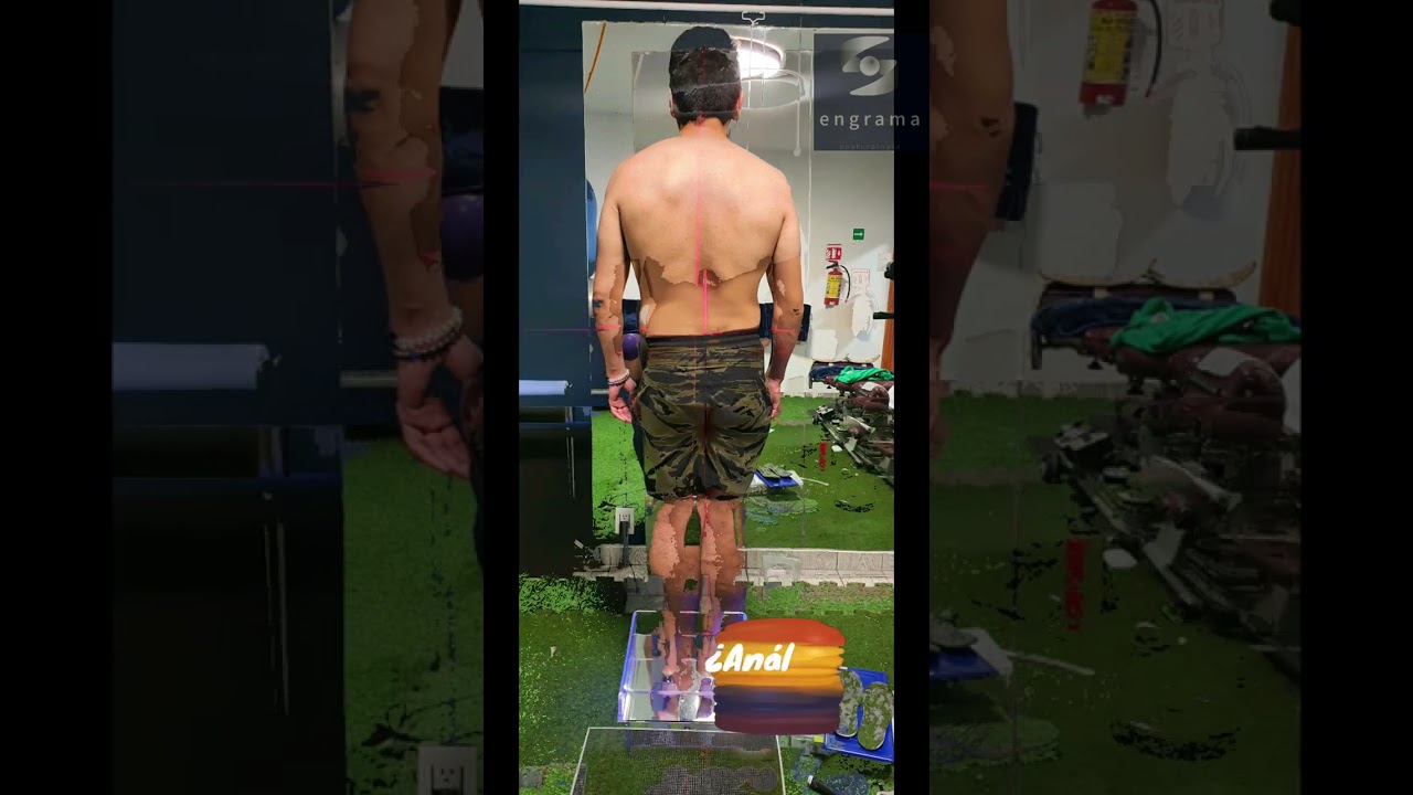 #analisis de #postura #posturologia #rehabilitaci&oacute;n #fisioterapia #coloniadelvalle #cdmx