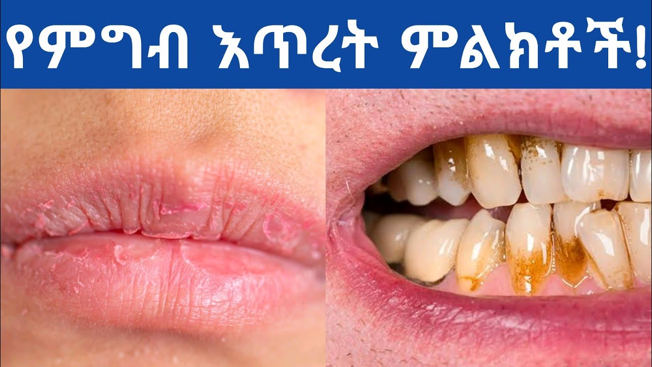 የተመጣጠነ ምግብ እጥረት 11 ምልክቶች| የቫይታሚን እና ማዕድናት እጥረት ምልክቶች| 11 signs of nutrients deficiencies