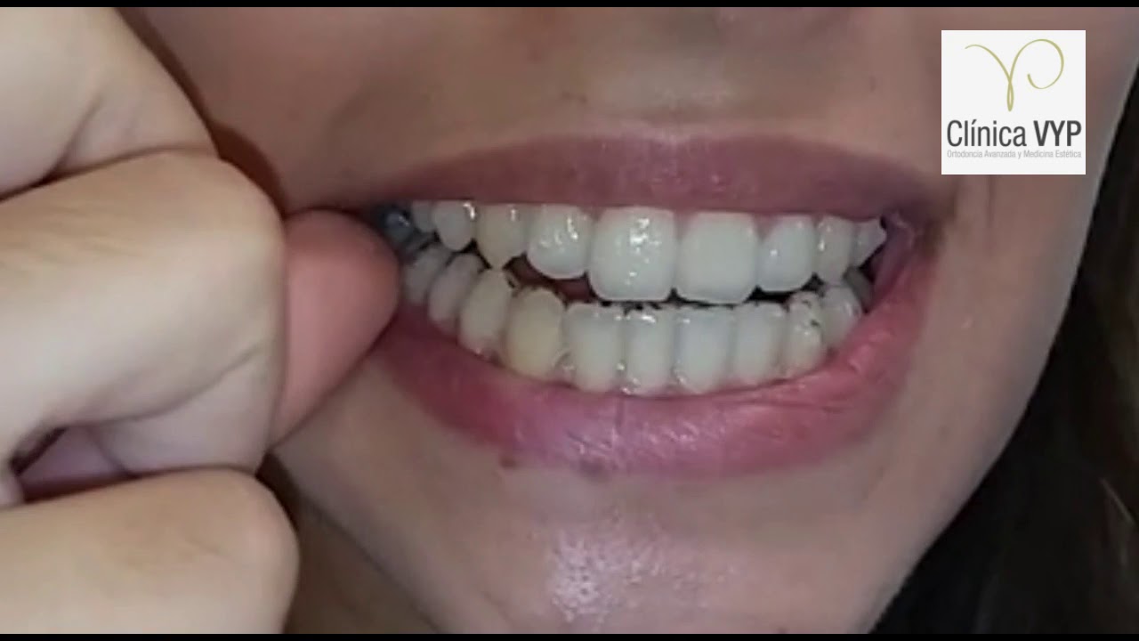Colocación, desinserción e higiene de los alineadores Invisalign. Dr. Samuel Verdugo. Clínica VYP.