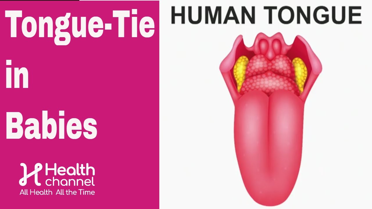 Tongue-Tie in Babies