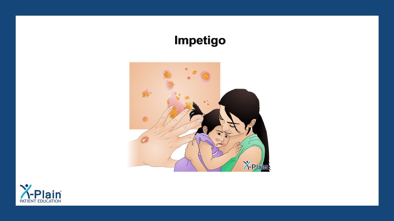 Impetigo