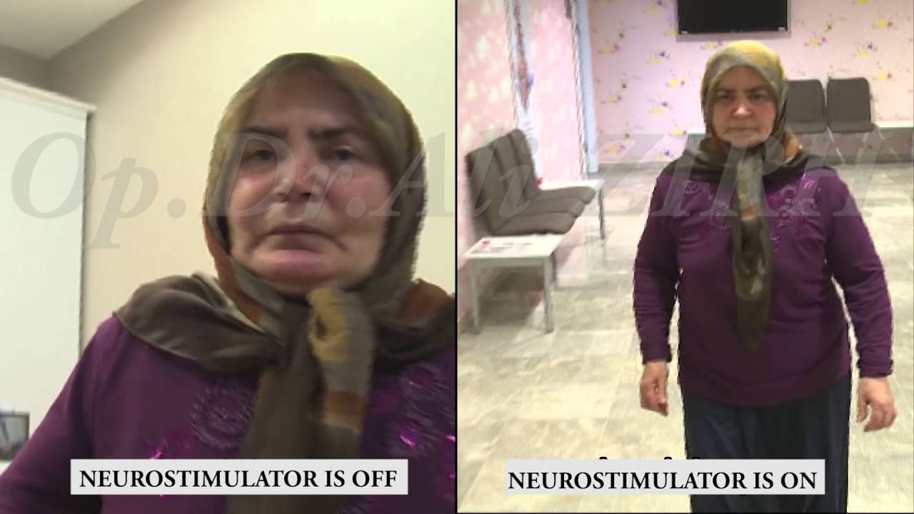 DBS-On and Off Surgery Parkinson's Treatment in Turkey Surgery Date 22.07.2005