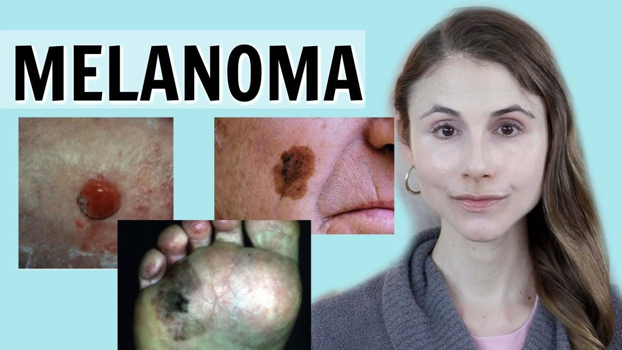 Melanoma skin cancer: Q&A with dermatologist Dr Dray