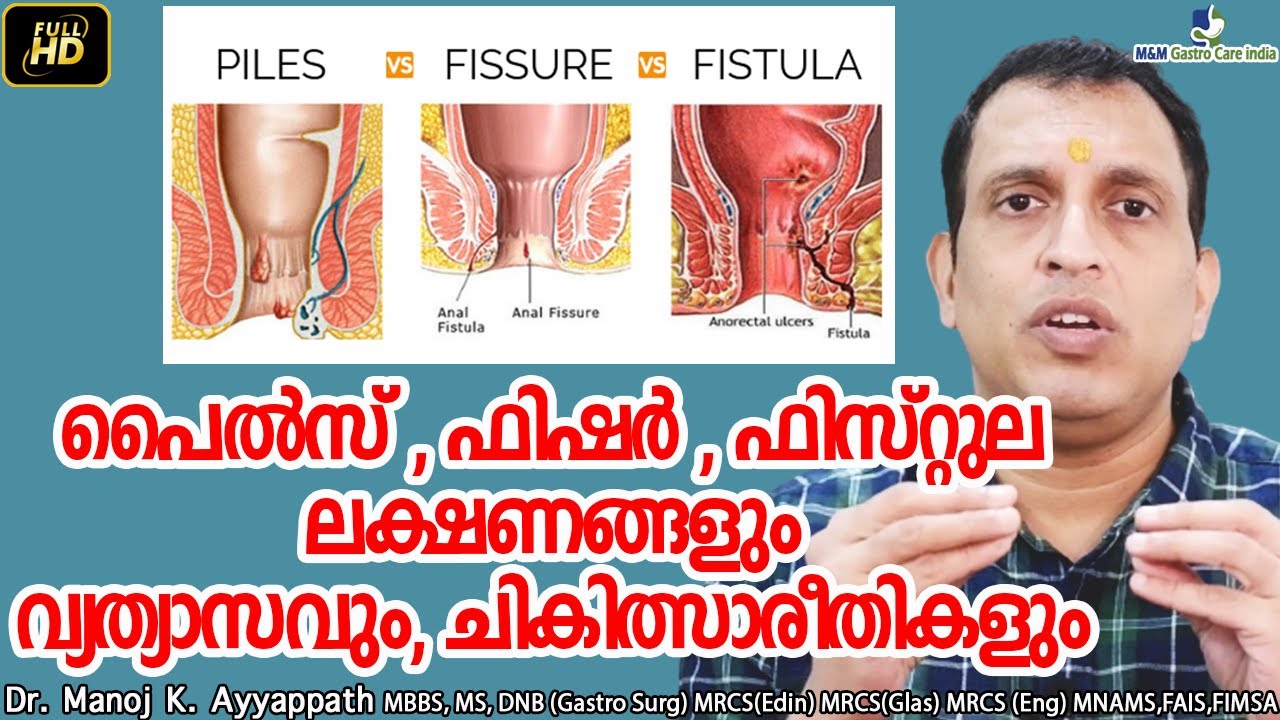 പൈൽസ് ഫിഷർ ഫിസ്റ്റുല ലക്ഷണങ്ങളും വ്യത്യാസവും ചികിത്സാരീതികളും | M&M Gastro Care India