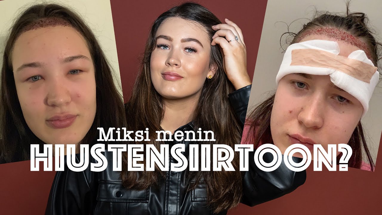 Hiustensiirtoleikkaus: HINTA, PAIKKA, SYY 😳