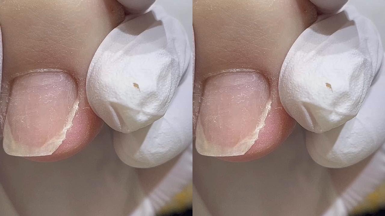 修复一下破破烂烂的大拇哥
#脚趾甲 #修脚#嵌甲#甲沟炎#甲型调整