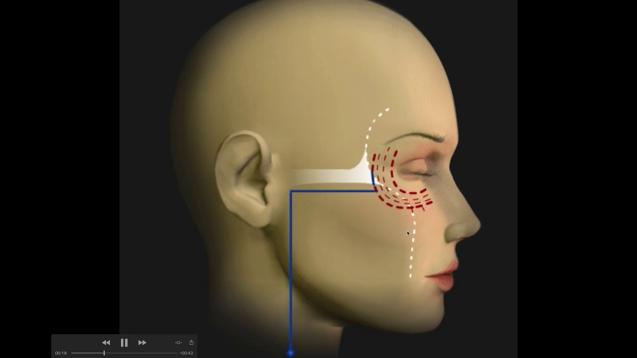 Multivectors facelift - Dott. Antonio Distefano