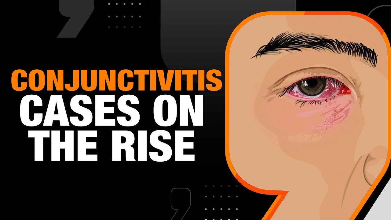 Conjunctivitis Cases Surge After Heavy Rains | How Does Eye Flu Spread? | News9