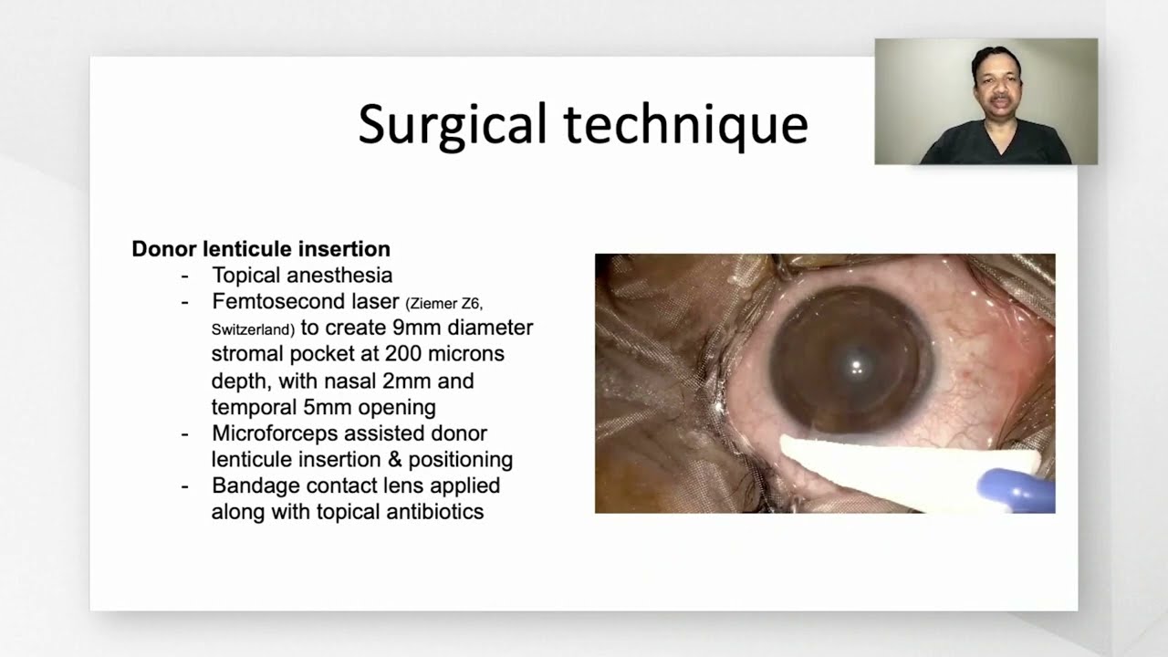 Dr. Rajesh Fogla presents Femtosecond laser-assisted stromal augmentation for keratoconus