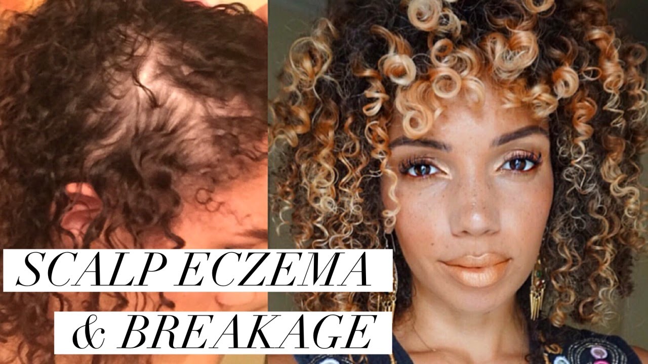 SCALP ECZEMA & NAPE BREAKAGE | Remedies/ Natural Products