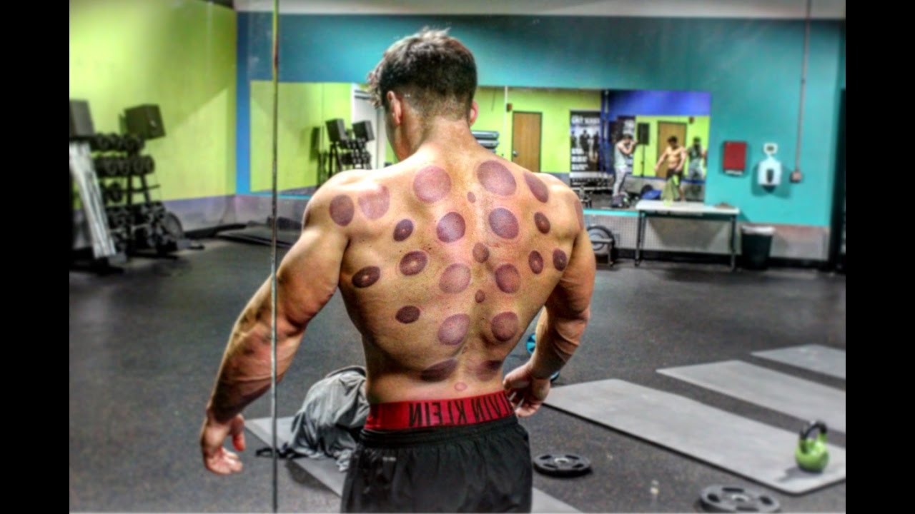 Insane Chinese Cupping experience, With the Aftermath!