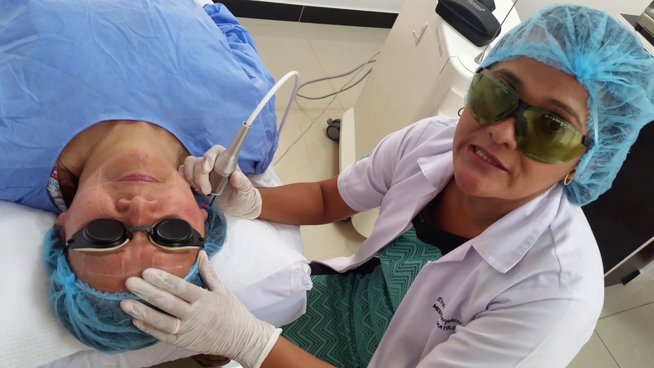 TRATAMIENTO LASER ROSACEA