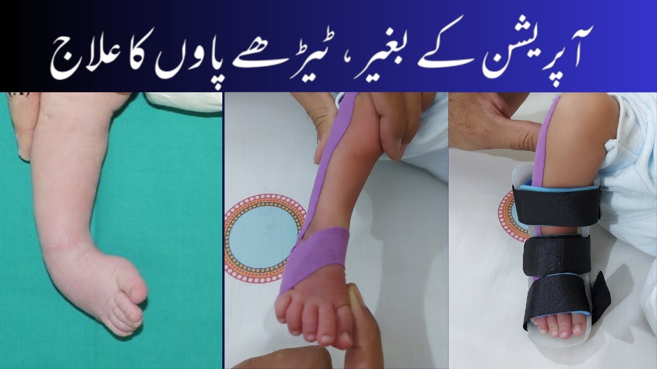 Club foot physiotherapy treatment | Exercises,Taping,Splint ٹیڑھے پاوں کا علاج #stretching #physio