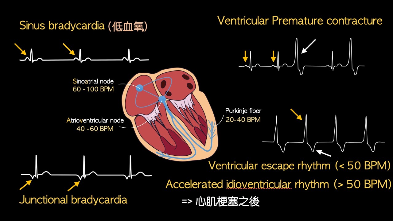 心臟內科2 Bradycardia (心搏過慢)