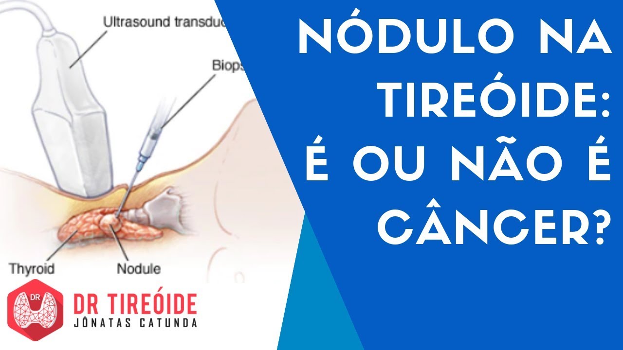 🔴 Nódulo na tireóide: é ou não é câncer? | Dr Tireóide Responde #62#