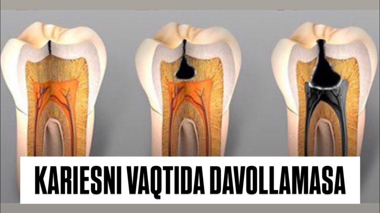 Kariesni vaqtida davollamasa Nima boladi ? #shifokor#dentist#rek#tibbiyot#dentalclinic 