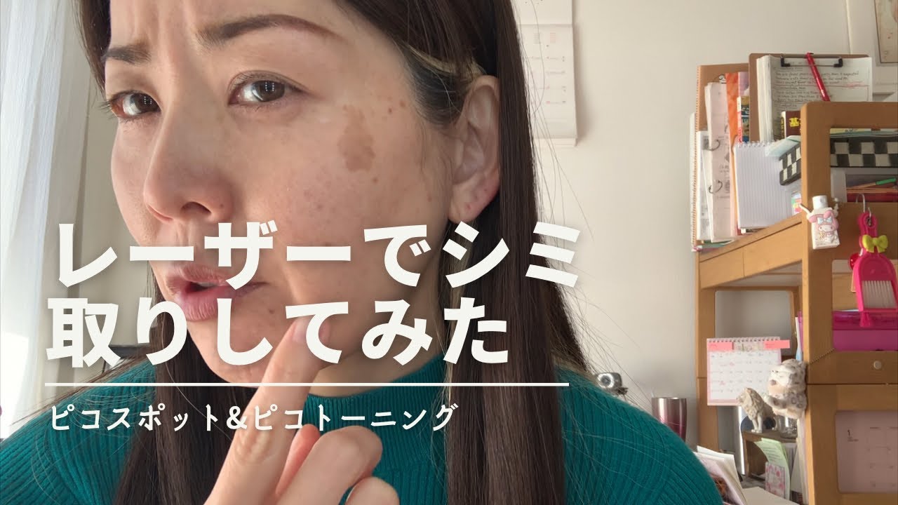 【シミ取り】45才・初めてのレーザーシミ取り体験記・ダウンタイムの様子（ピコスポット・ピコトーニング）