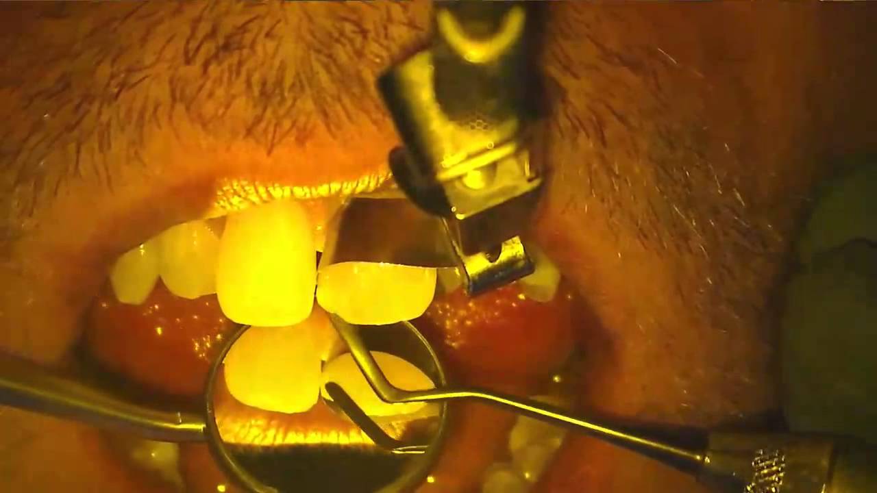 Fixing a Gap Between the Front Teeth
