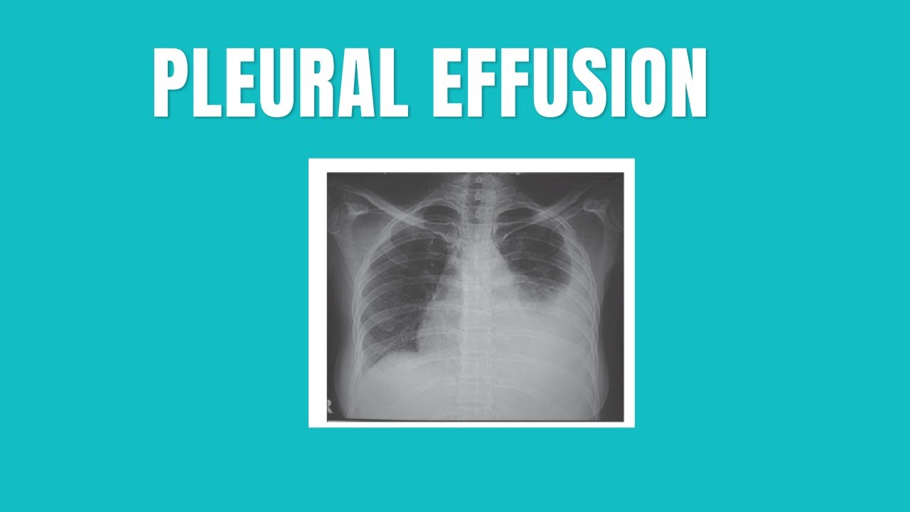 Overview of Pleural Effusion