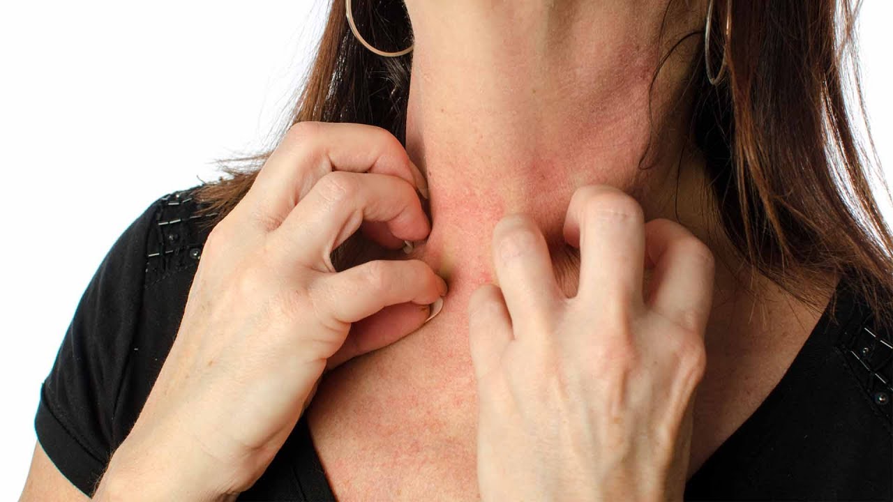 Myths about Eczema