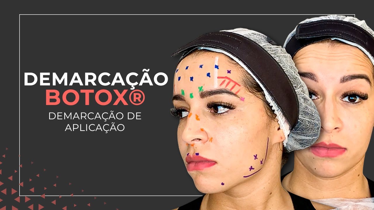 DEMARCAÇÃO TOXINA BOTULÍNICA - ÁREAS DE APLICAÇÃO