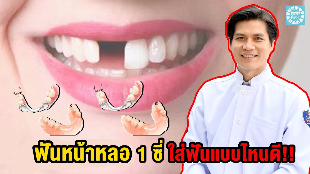 ฟันหน้าหลอ 1 ซี่ ใส่ฟันแบบไหนดี!!