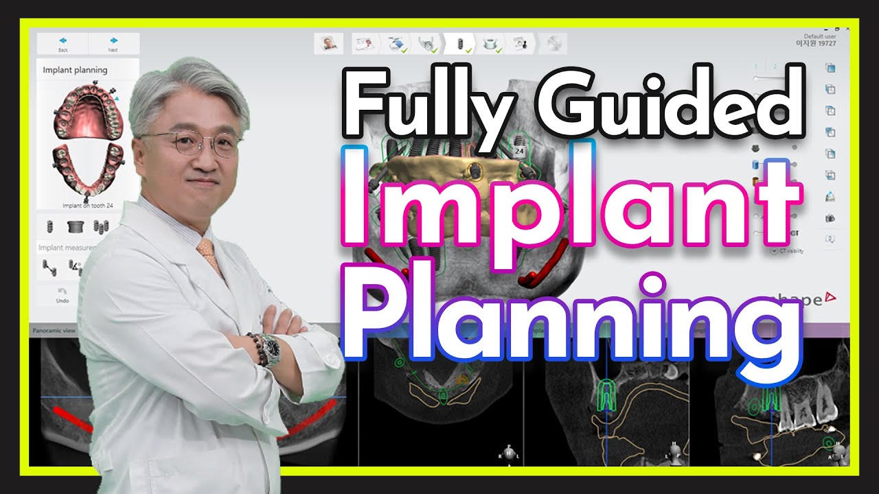 [DIGITAL DENTISTRY] Fully Guided Implant Planning Using Implant Studio SW
