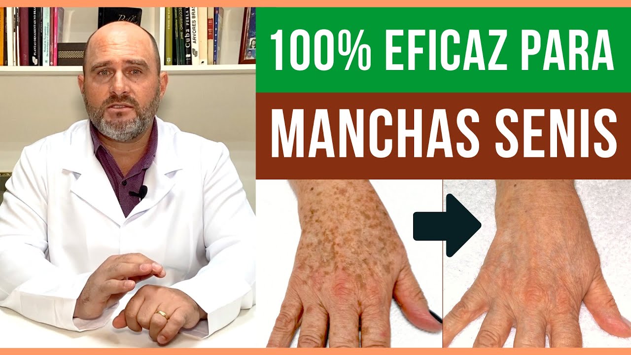 Manchas Senis nas MÃOS e no ROSTO? [ ESSE É GARANTIDO ] Como tirar estas manchas escuras da pele