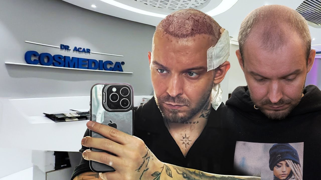 HAIR TRANSPLANT AT COSMEDICA (KIDNEY PATIENT)