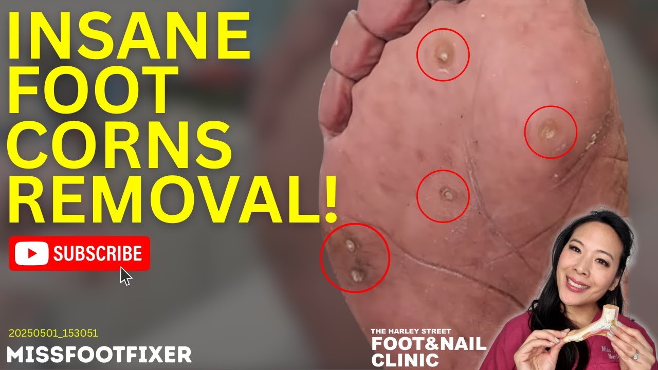 Removing Multiple Painful Corns | MissFootFixer