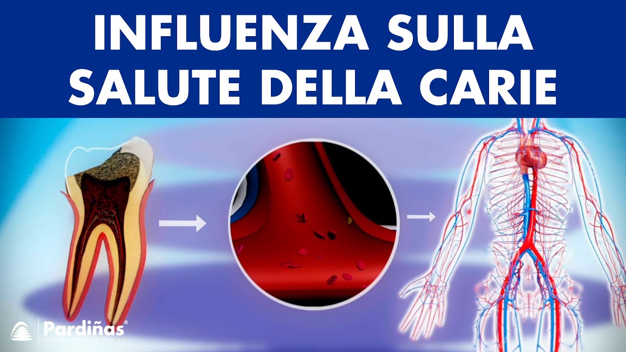Carie denti e la sua influenza sulla salute ©