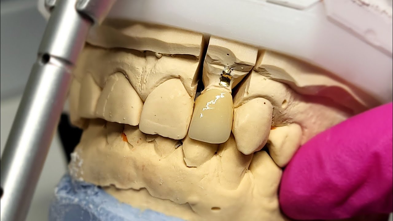 ASMR Glaze and Stain / Zirconia / Full Contur Crown