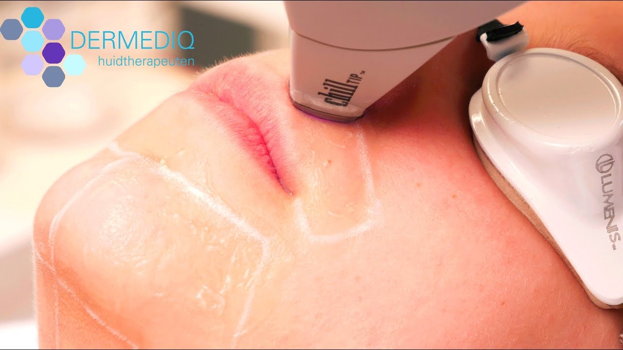 Laserbehandeling bij ongewenste haargroei