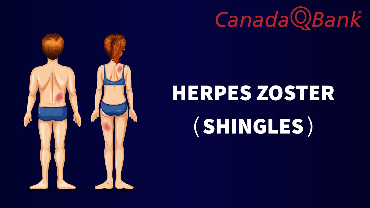 Herpes Zoster (Shingles): Causes, Symptoms & Treatment | Varicella-Zoster Virus Reactivation