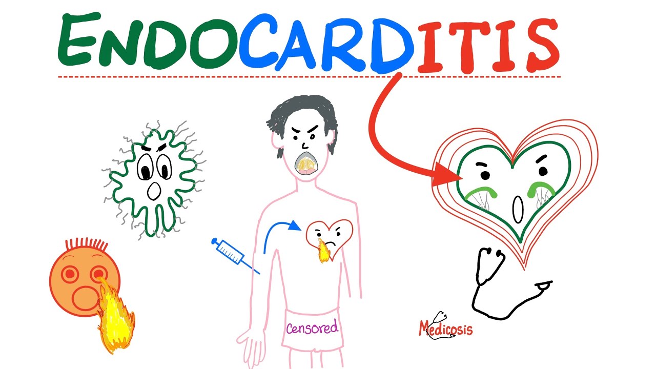 Infective Endocarditis - Fever & New Murmur - Modified Duke’s Criteria - Cardiology Playlist