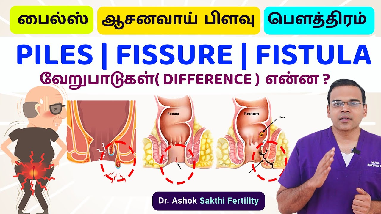 Difference Between Piles | Fissure | Fistula (பைல்ஸ்,பிளவு மற்றும் பௌத்திரம்) மூலநோய் பிரச்சனைகள் ??