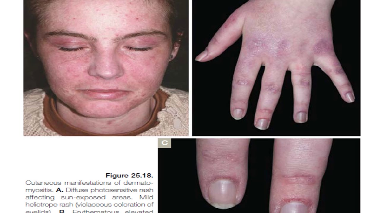 07 Dermatomyositis Dr Enas Zahran