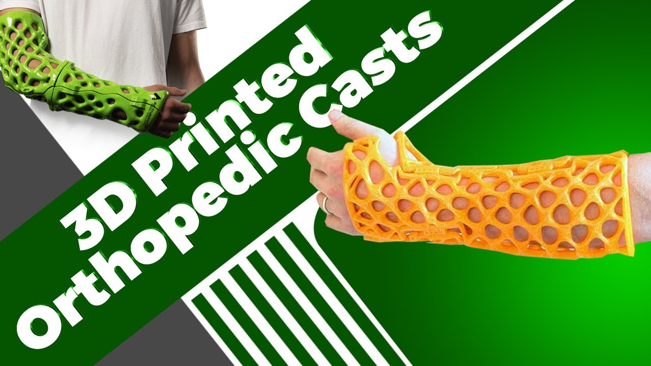 3D Printed Casts: Find Out the Cost, Materials Used & Major Companies Creating 3D Printed Orthotics