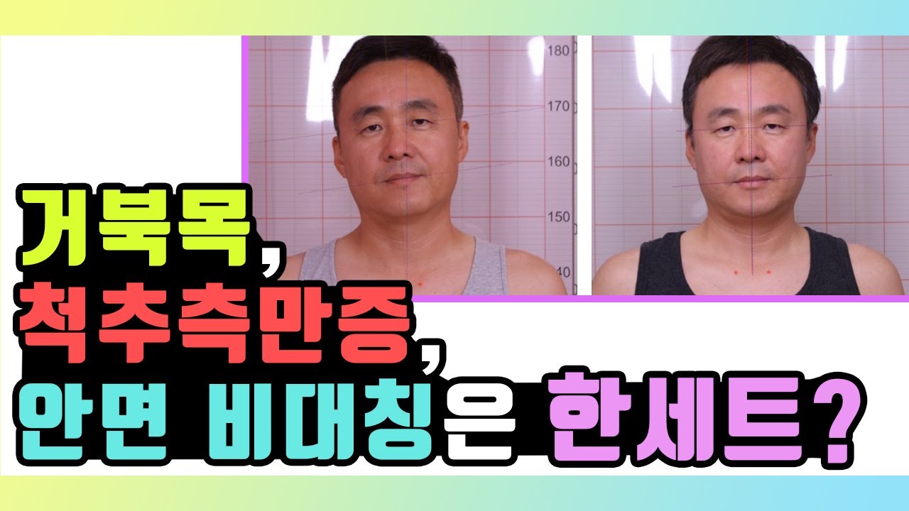 거북목,  척추측만증, 안면비대칭은 한세트다!? ( 자세불균형, 척추불균형과 얼굴비대칭의 상관관계)