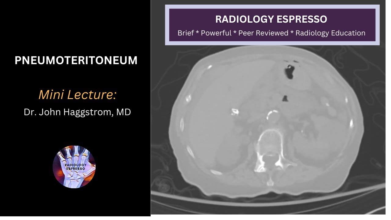 PNEUMOPERITONEUM: Mini Lecture, Dr. John Haggstrom, MD
