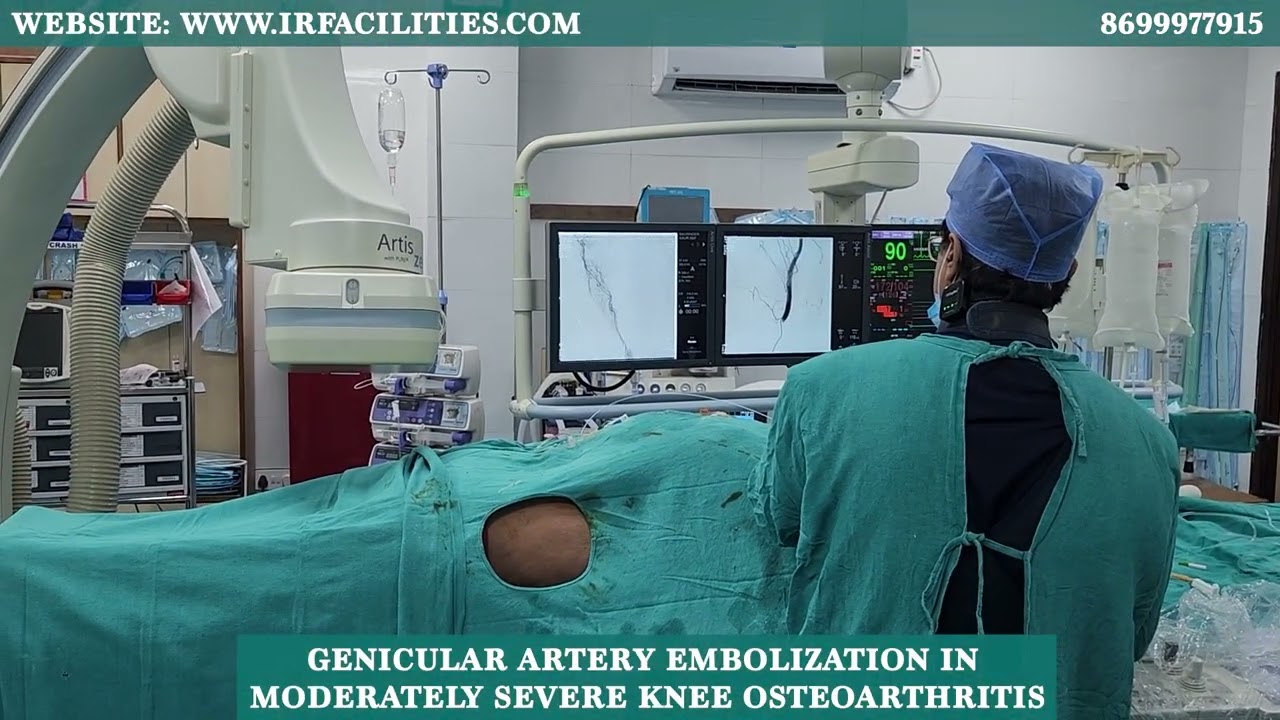Genicular Artery Embolization for Moderate Knee Osteoarthritis | Dr. Sandeep Sharma | IRFACILITIES