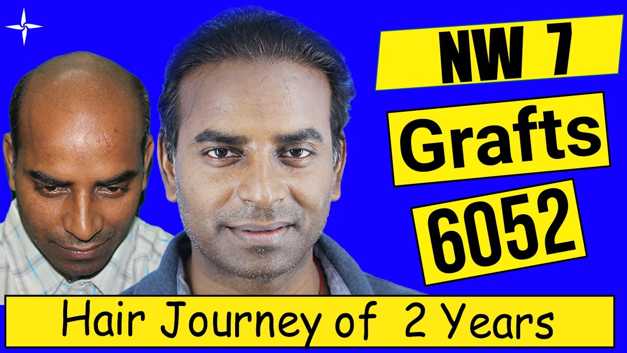 Difficult Hair Transplant in Grade 7; 6052 grafts in Eugenix by Dr Pradeep Sethi and Arika Bansal