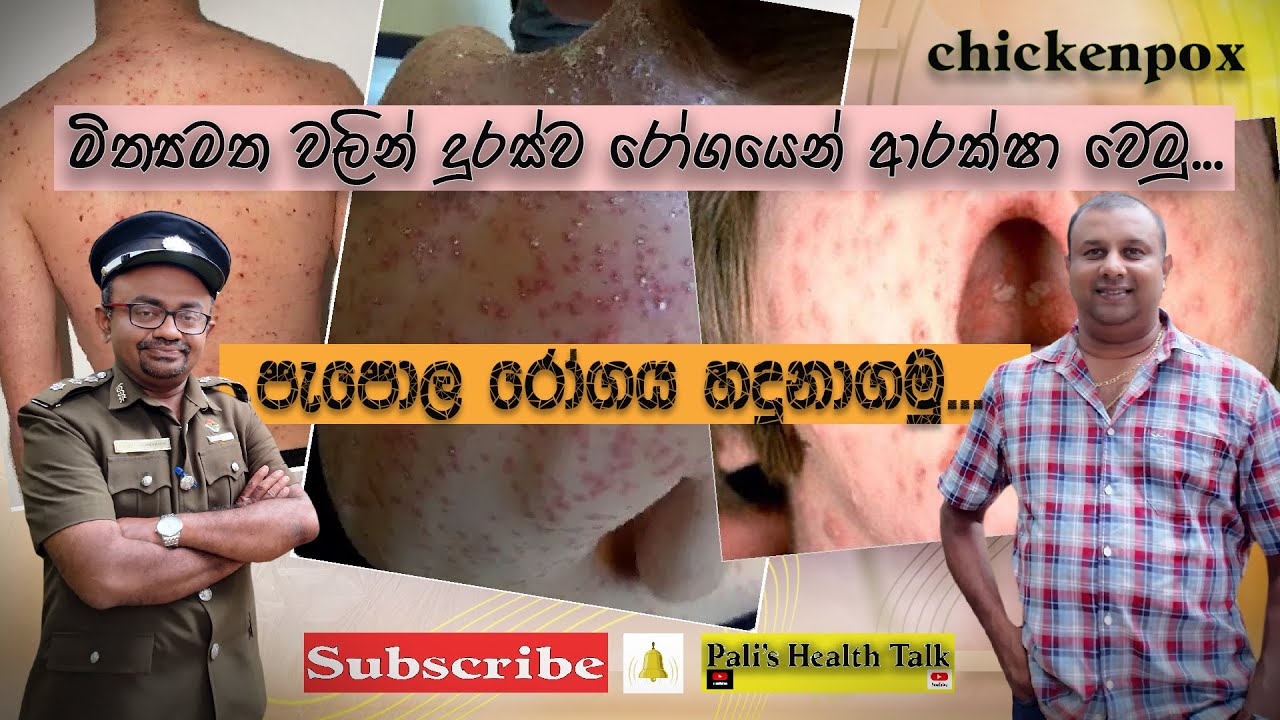 Chickenpox හෙවත් පැපොල රෝගය.