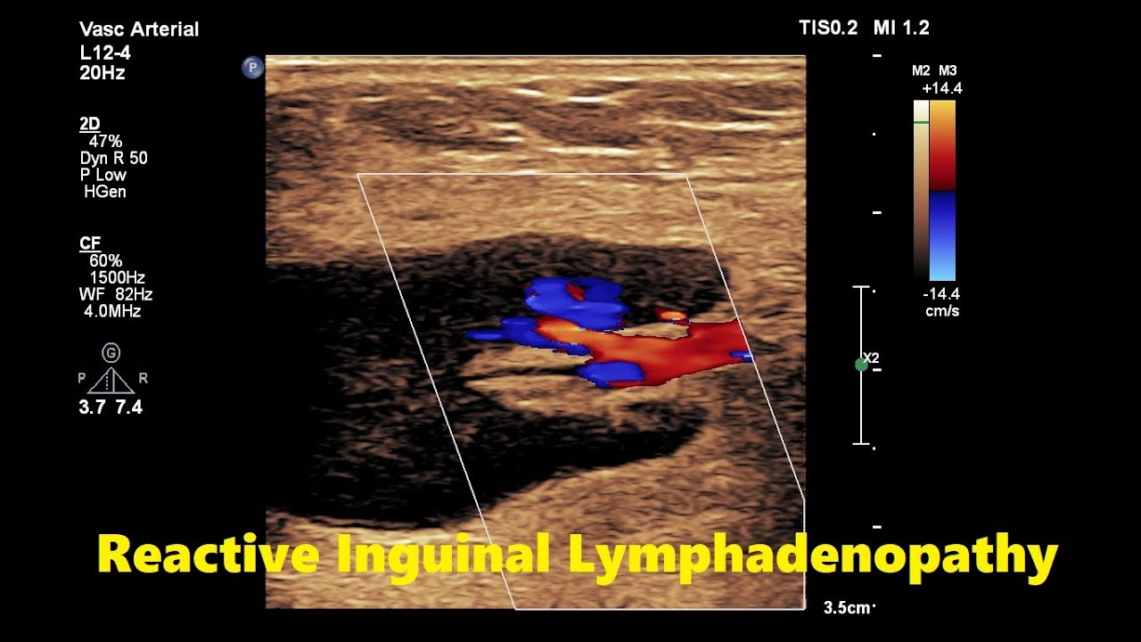 Reactive Inguinal Lymphadenopathy || Ultrasound || Doppler || Case 03