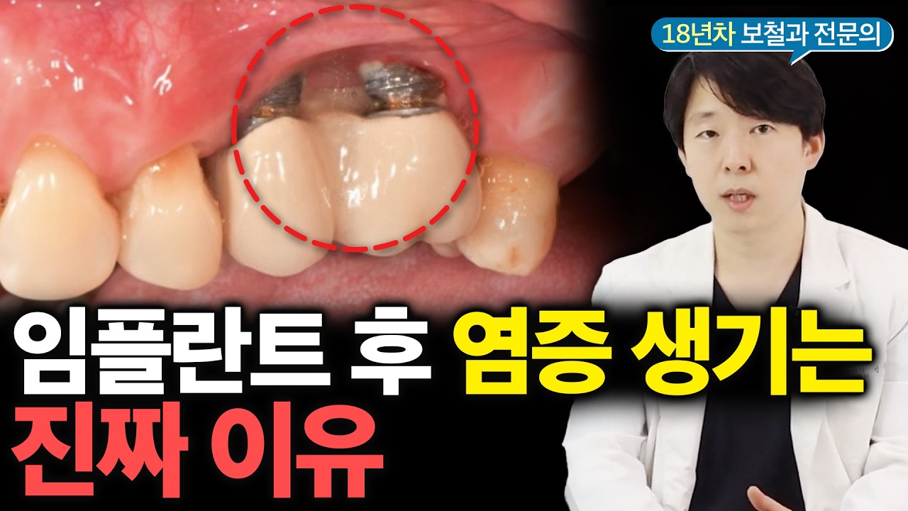 임플란트 주위염, 염증 생기는 이유? 해결법까지 알려드립니다