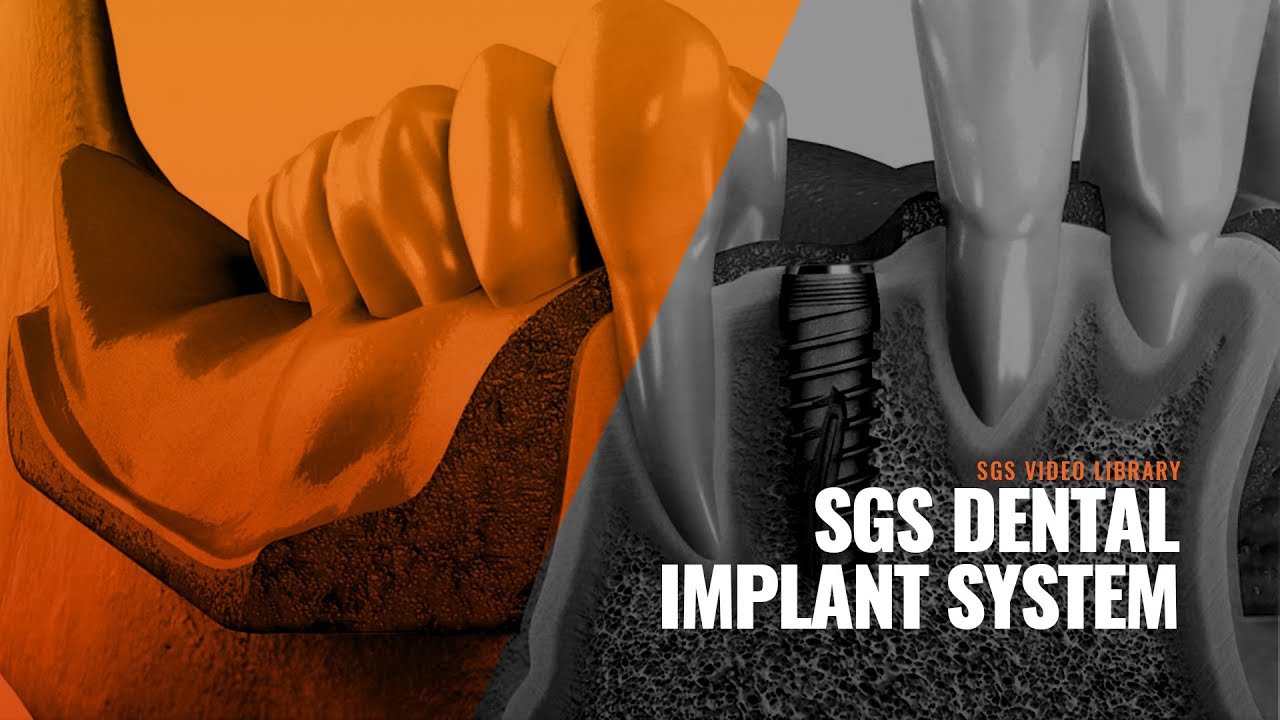 SGS Dental Implant System