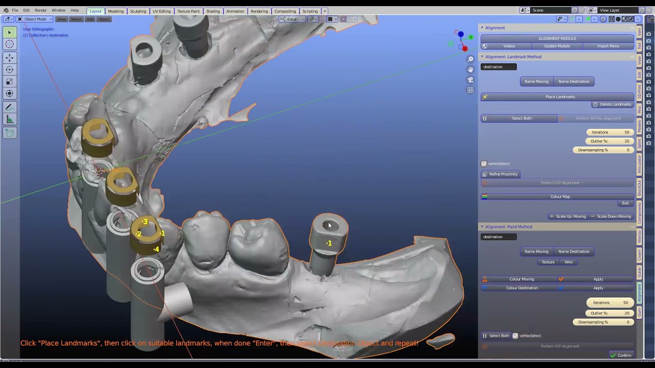 Zoom- IPD implant Model