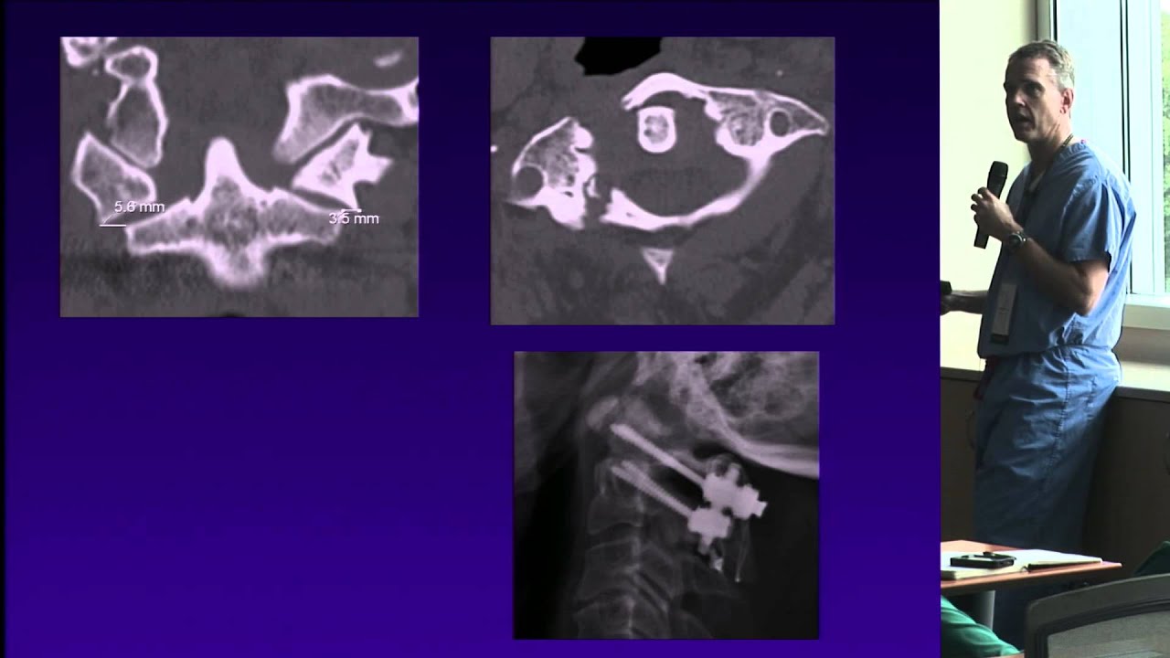 Posterior Options for C1-2 Fixation by Andrew T. Dailey, M.D.