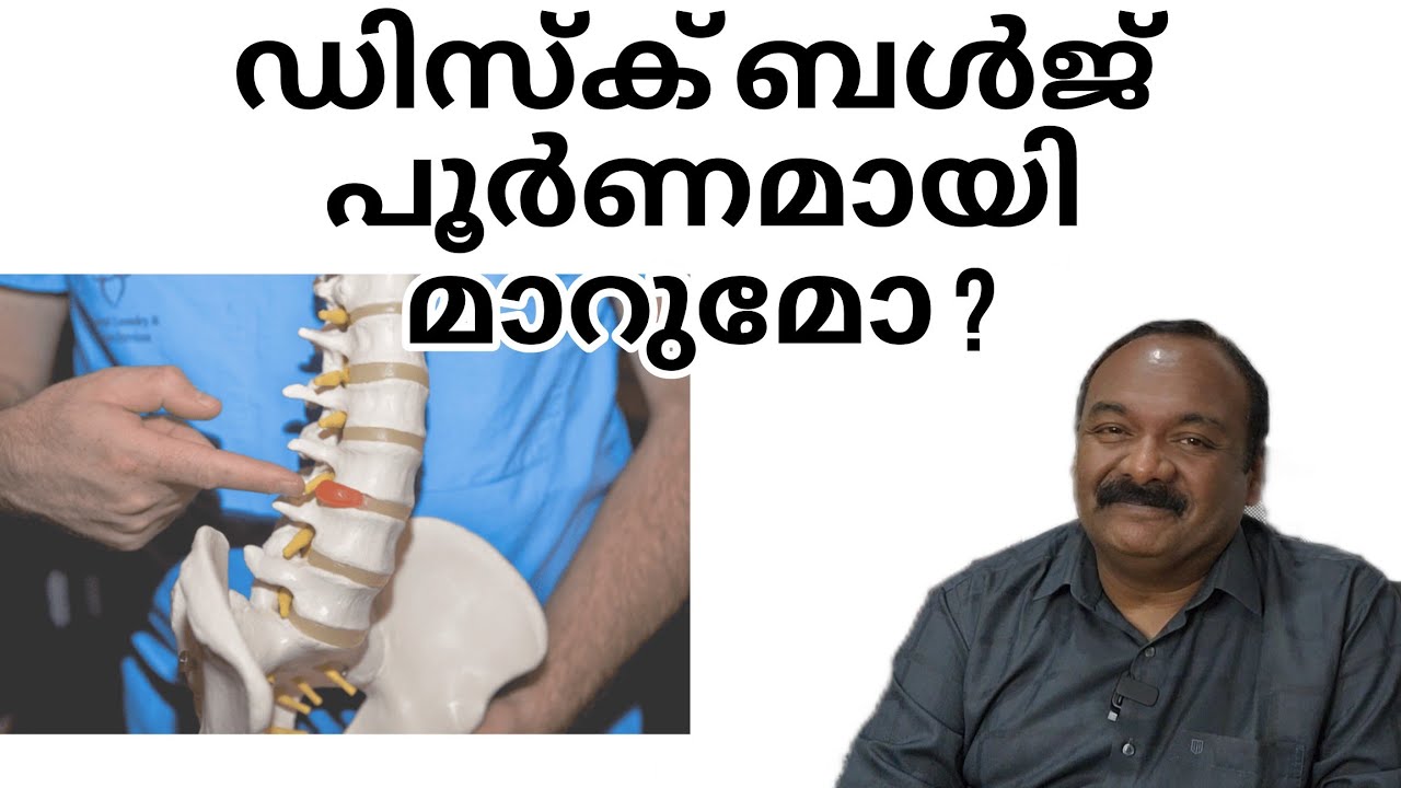 ഡിസ്ക് ബൾജ് മാറുമോ | Will disk bulge heal completely