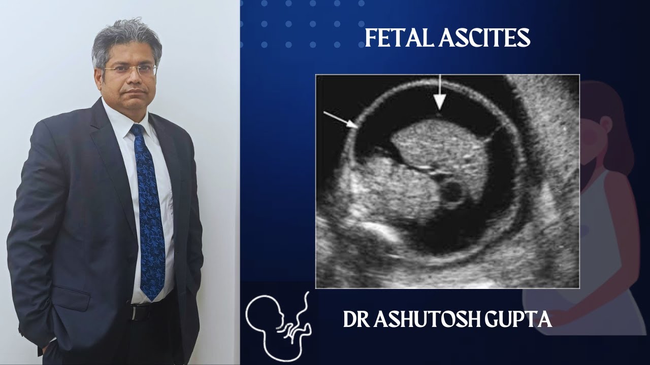 Fetal Ascites